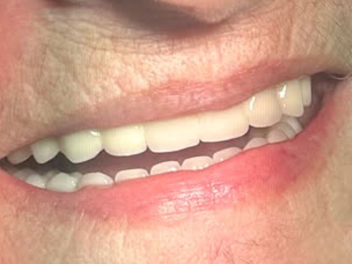 Fix on four Implantate – Behandlung
